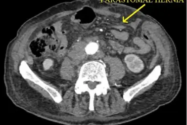 83-Year-Old Man Faces Life-Threatening Spontaneous Evisceration After Routine Hernia Repair