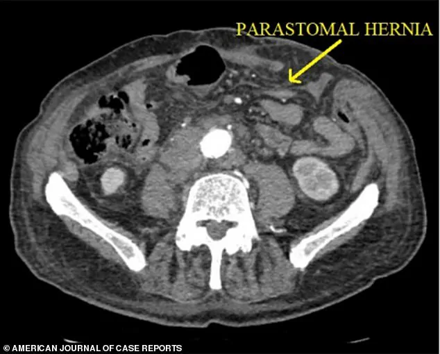 83-Year-Old Man Faces Life-Threatening Spontaneous Evisceration After Routine Hernia Repair