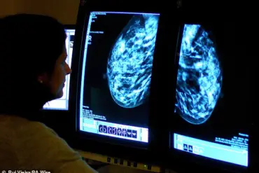 Potential Shift in UK Breast Cancer Screening: Groundbreaking Trial Led by Dr. Sacha Howell Calls for Checks in Women's 30s