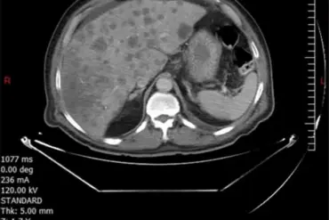 Rare Aggressive Colon Cancer Claims Life of Lebanese Man Weeks After Diagnosis