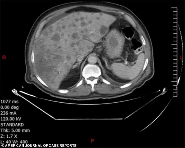 Rare Aggressive Colon Cancer Claims Life of Lebanese Man Weeks After Diagnosis