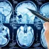 Study Indicates Carbohydrate Reduction May Help Lower Alzheimer's-Related Proteins