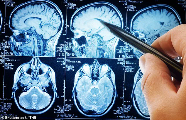 Study Indicates Carbohydrate Reduction May Help Lower Alzheimer's-Related Proteins