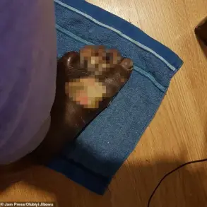 Man's DIY Pedicure Leads to Life-Threatening Infection and Leg Amputation