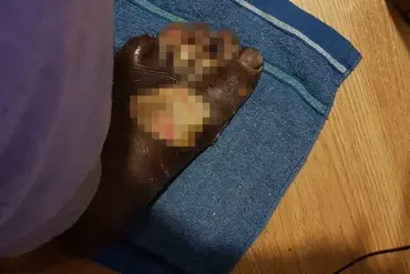 Man's DIY Pedicure Leads to Life-Threatening Infection and Leg Amputation