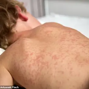 Measles Outbreak in Texas: Father's Efforts to Vaccinate Son Highlight Free Clinic Access