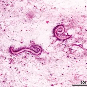 Parasitic Infections Linked to Kidney Transplants from Deceased Donor Spark Calls for Stricter Screening Protocols