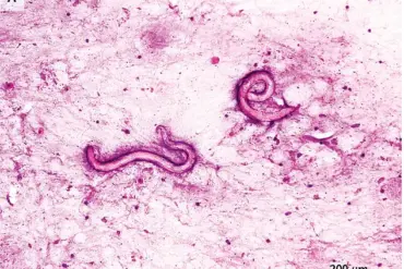 Parasitic Infections Linked to Kidney Transplants from Deceased Donor Spark Calls for Stricter Screening Protocols