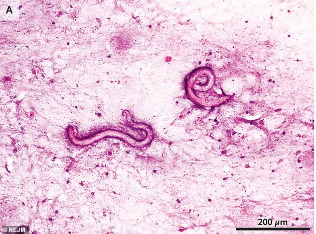 Parasitic Infections Linked to Kidney Transplants from Deceased Donor Spark Calls for Stricter Screening Protocols