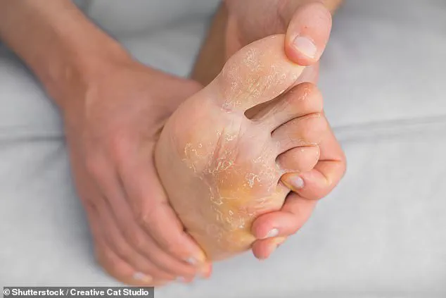 Podiatrist Maddie Tait Warns: 'Neglecting Foot Hygiene and Poor Footwear Choices Can Lead to Blisters and Cracked Heels—Especially in Summer'