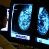 Study Links Certain Hormone Replacement Therapies to Increased Breast Cancer Risk in Younger Women, Prompting Expert Advisories