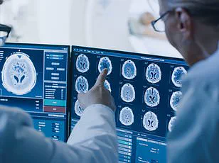 Study Links Gabapentin, Widely Prescribed for Back Pain, to Increased Dementia Risk