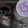 Tick Bites Linked to Deadly Allergic Reaction: Public Health Alert on Alpha-Gal Syndrome