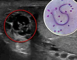 Tick Bites Linked to Deadly Allergic Reaction: Public Health Alert on Alpha-Gal Syndrome