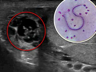 Tick Bites Linked to Deadly Allergic Reaction: Public Health Alert on Alpha-Gal Syndrome