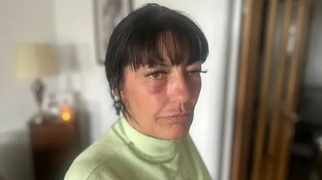Unlicensed Botox Procedure Sparks Calls for Stricter Cosmetic Regulation After Life-Threatening Incident
