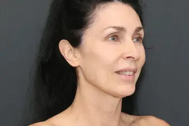 When AI Judges Beauty: The Unexpected Impact of ChatGPT on Plastic Surgery and Aesthetic Standards