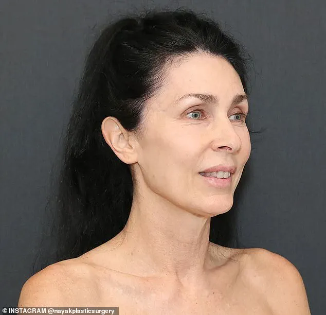 When AI Judges Beauty: The Unexpected Impact of ChatGPT on Plastic Surgery and Aesthetic Standards