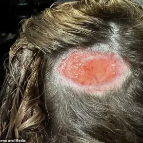 18-Year-Old North Carolina Teen Kyrie Martin Suffers Scalp Injury and Scar from Hair Dye Accident