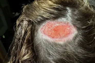 18-Year-Old North Carolina Teen Kyrie Martin Suffers Scalp Injury and Scar from Hair Dye Accident