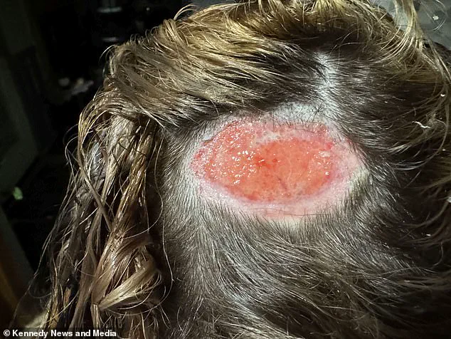 18-Year-Old North Carolina Teen Kyrie Martin Suffers Scalp Injury and Scar from Hair Dye Accident