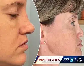 Alleged Malpractice at The Secret Plastic Surgery Clinic: A Patient's Traumatic Journey Following a Breast Lift and Enlargement