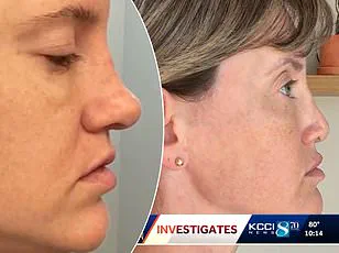 Alleged Malpractice at The Secret Plastic Surgery Clinic: A Patient's Traumatic Journey Following a Breast Lift and Enlargement