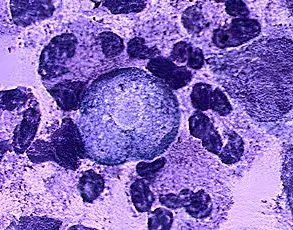 As Global Temperatures Rise, Brain-Eating Amoeba Spreads: Urgent Calls for Environmental Safeguards to Prevent Public Health Crisis