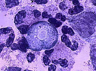 As Global Temperatures Rise, Brain-Eating Amoeba Spreads: Urgent Calls for Environmental Safeguards to Prevent Public Health Crisis
