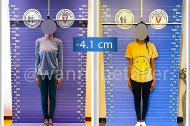 Controversial Procedure: Leg-Shortening Surgery Among Tall Women Driven by Societal and Personal Factors