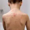 NHS Expands Childhood Vaccination Programme with Chickenpox Vaccine for Babies, 98% Effective