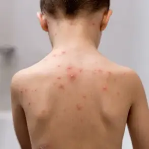 NHS Expands Childhood Vaccination Programme with Chickenpox Vaccine for Babies, 98% Effective