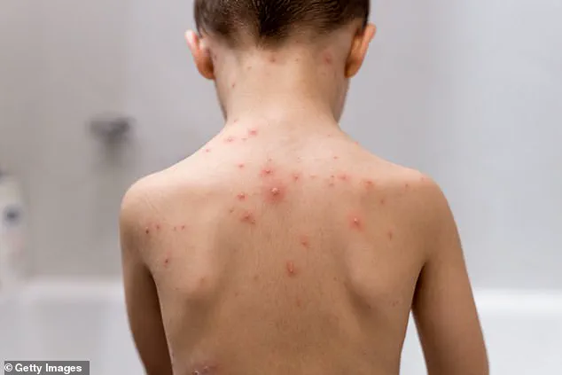 NHS Expands Childhood Vaccination Programme with Chickenpox Vaccine for Babies, 98% Effective