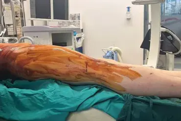 Risky Pursuit of Height: UK Men Undergo Painful, Costly Surgery Abroad