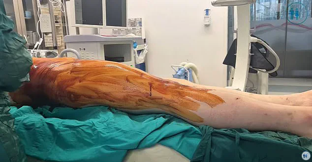 Risky Pursuit of Height: UK Men Undergo Painful, Costly Surgery Abroad