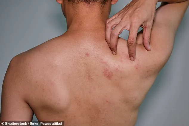 Study Suggests Shingles Vaccine May Reduce Heart Attack and Stroke Risk by 20%, Prompting Review of Current Guidelines