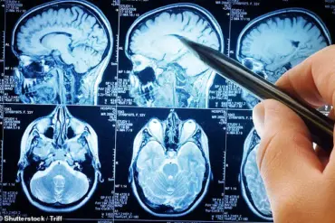 UCL Scientists Uncover Potential Method to Stop Glioblastoma Spread