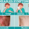 Urgent Call to Vaccinate Children as Measles Cases Surge During Summer Holidays