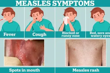 Urgent Call to Vaccinate Children as Measles Cases Surge During Summer Holidays