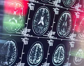 Breakthrough in Early Dementia Detection: New Brain Imaging Technique Predicts Disease Decades in Advance