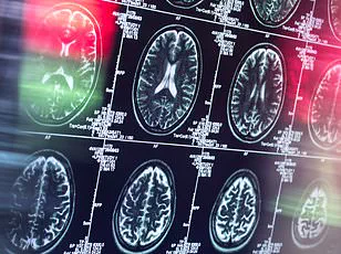 Breakthrough in Early Dementia Detection: New Brain Imaging Technique Predicts Disease Decades in Advance